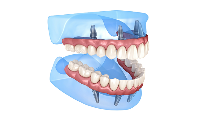 Illustration of dentures attached to All-on-4 dental implants