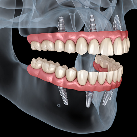 Illustration of dentures attached to upper and lower jaw with All-on-4 procedure