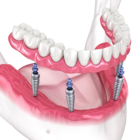 Illustration of dental implants and dentures being placed in jaw