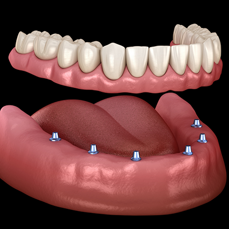 Illustration of dentures held above All-on-6 dental implants