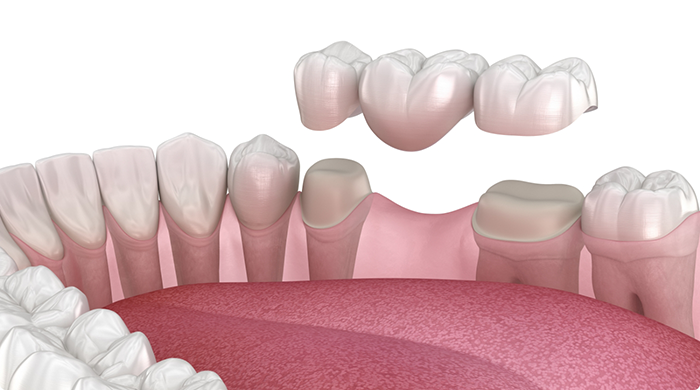 Illustration of dental bridge in Lancaster being placed on teeth in lower jaw