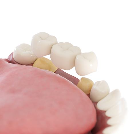 Model of dental implant being placed on yellow model abutment teeth