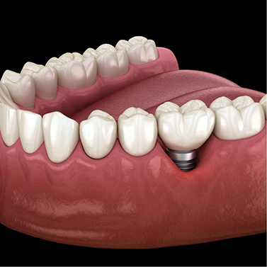 Illustration of single dental implant and crown used to replace tooth