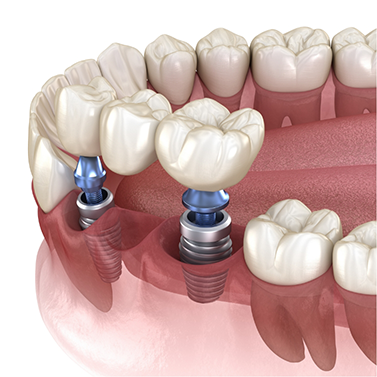 Illustration of dental bridge attached to dental implants