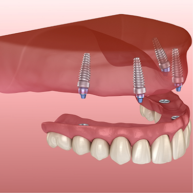Illustration of full denture being attached to dental implants