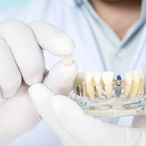 Dentist with gloves holding model of dental implant along with dental crown