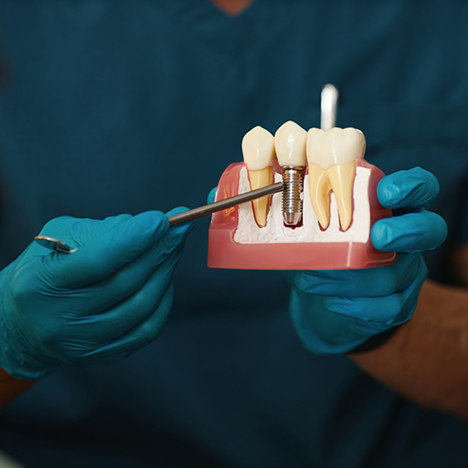Pointing to model of dental implant