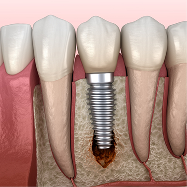 Illustration of bone loss around dental implant