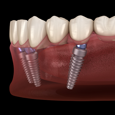 Illustration of dentures attached to dental implants