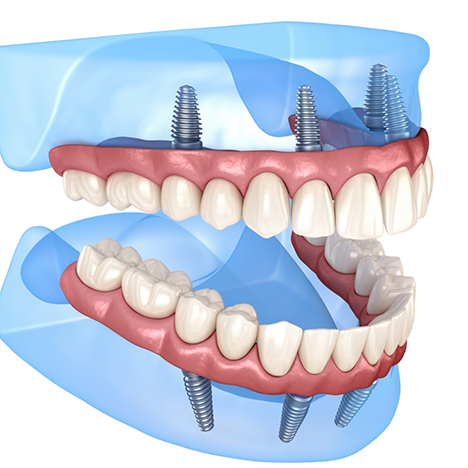 Illustration of dentures attached to dental implants