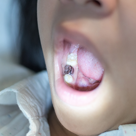 Child opening mouth to show decayed tooth