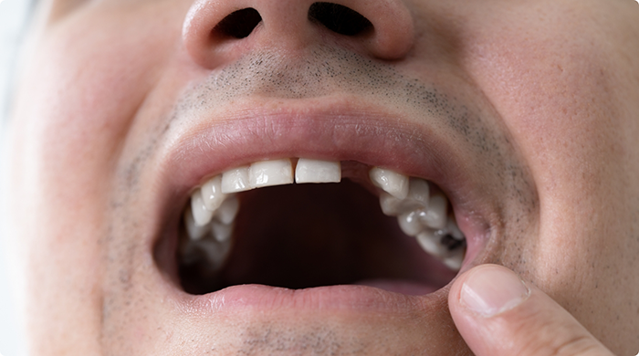 Close-up of man's mouth with gap left by missing tooth