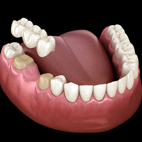 Illustration of dental bridge being placed on teeth in lower arch