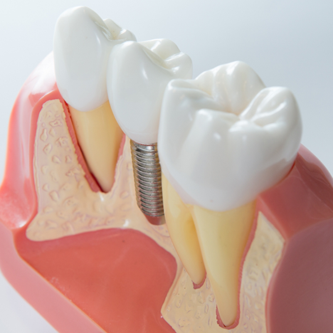 Close-up of model of dental implant