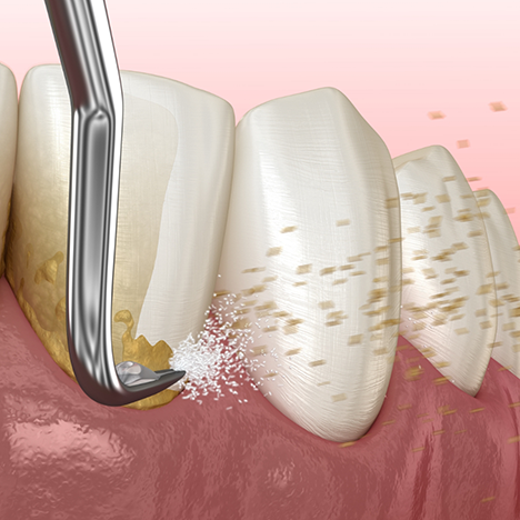 Illustration of scaling and root planing for gum disease treatment in Lancaster