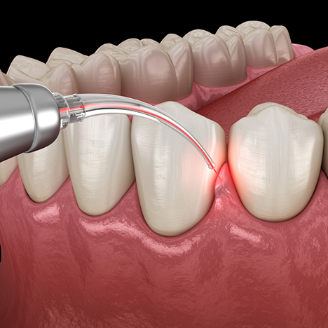 Illustration of laser being used to treat gums