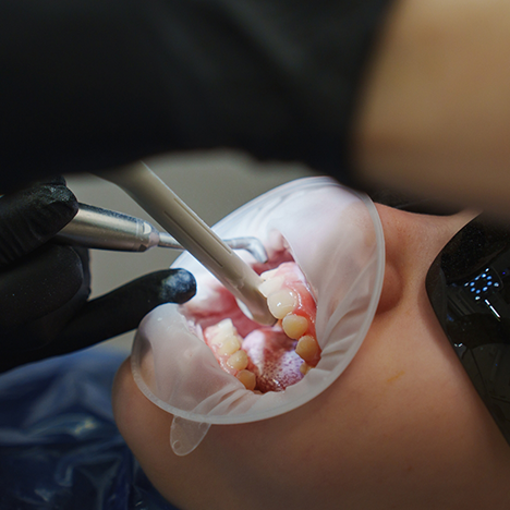 Dental patient receiving fluoride treatment