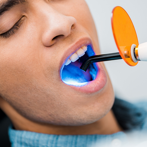 Man holding mouth open for dental bonding