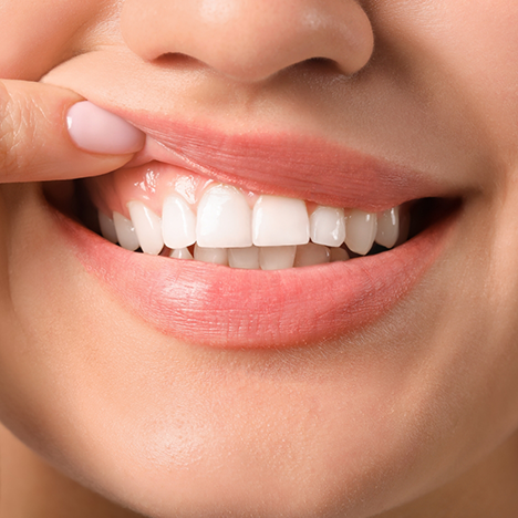 Close-up of woman pulling up lip to show gums
