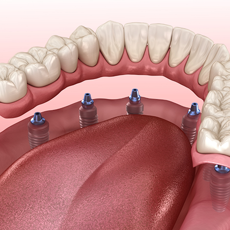 Dentures being attached to dental implant posts
