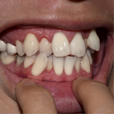 Close-up of smile with crowded teeth