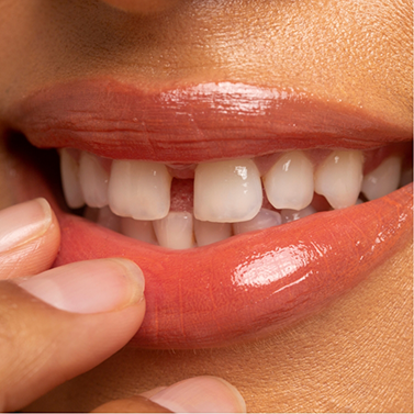 Close-up of smile with gap between front teeth