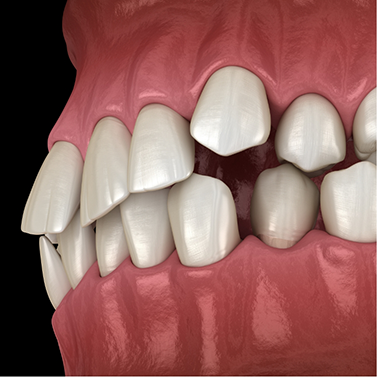 Illustration of a misaligned bite