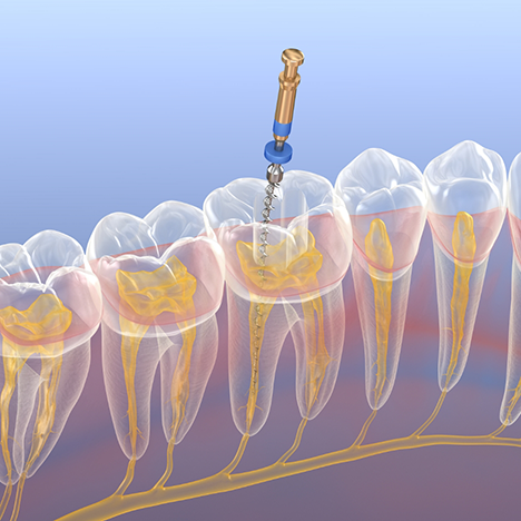 Illustration of root canal treatment in Lancaster