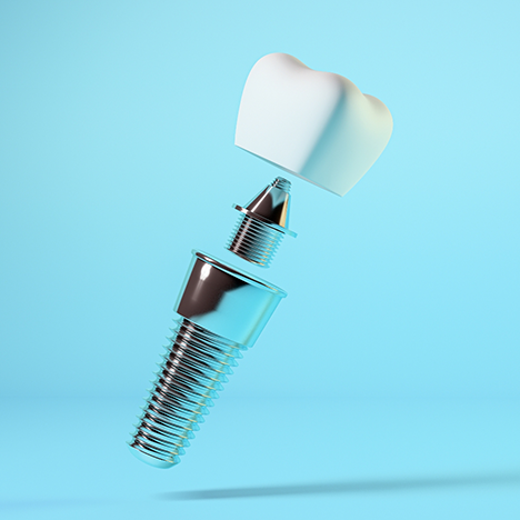 Illustration of dental crown, abutment, and denture