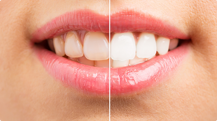 Smile before and after teeth whitening in Lancaster
