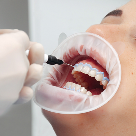 Patient having teeth whitening performed with protective cover on lips