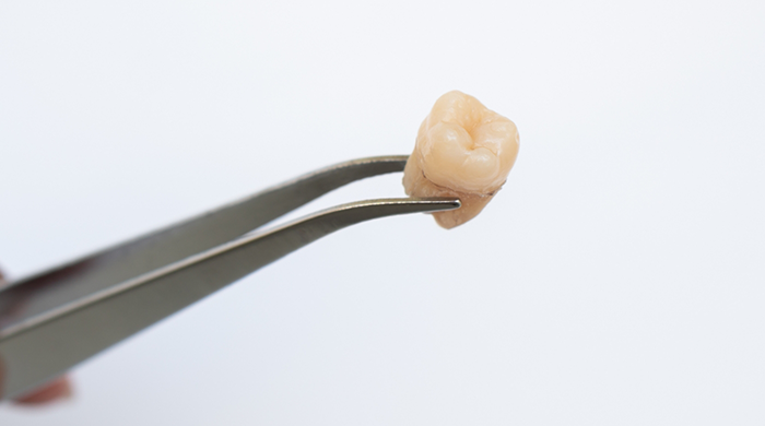 Forceps holding tooth after tooth extraction in Lancaster