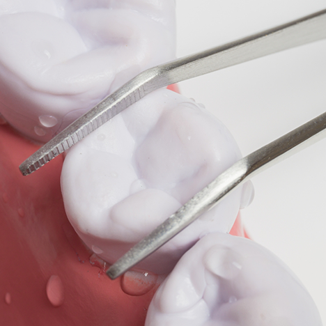 Overhead shot of forceps and tooth about to be extracted