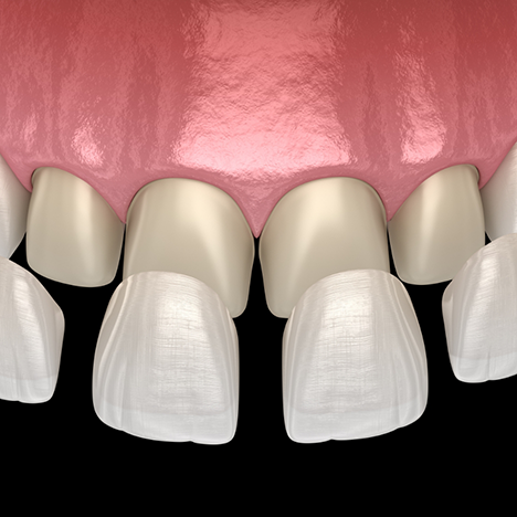 Illustration of veneers being placed on teeth