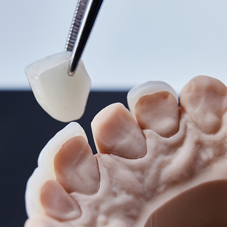 Veneers being removed from model of teeth