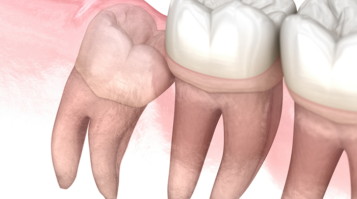 Illustration of impacted wisdom tooth in Lancaster