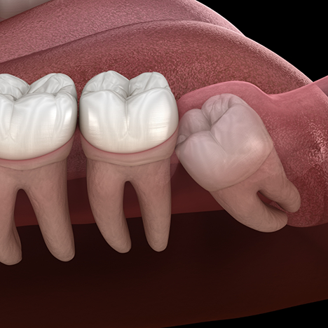 Illustration of wisdom tooth trapped under gums
