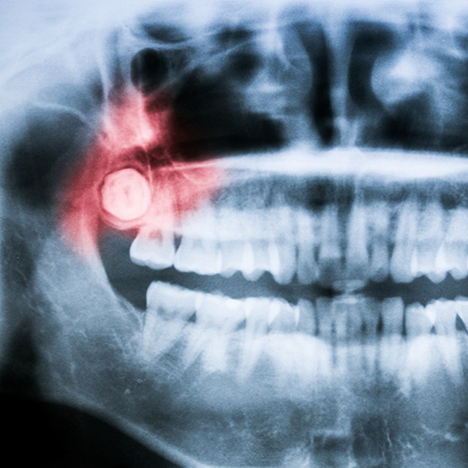 X-ray showing problematic wisdom tooth