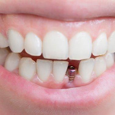 A placed dental implant without its final restoration