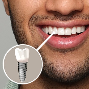 A photo highlighting a bearded man’s complete dental implant