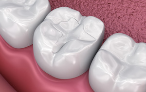 3D render of a dental filling